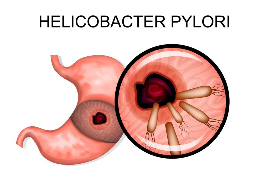 H pylori dietary recommendations